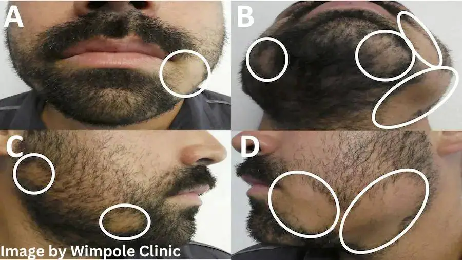 alopecia Barbae