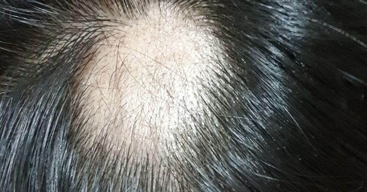 Best 5 Ways: How To Stop Alopecia Areata From Spreading