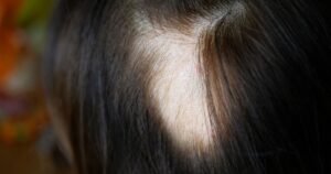 new treatment for alopecia areata 2024