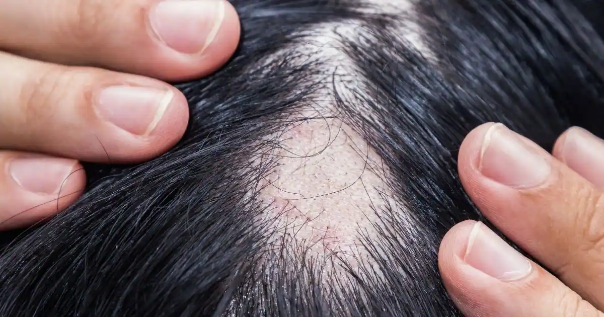 alopecia areata