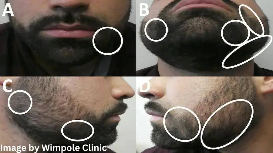 results of applying topical steroids for alopecia barbae