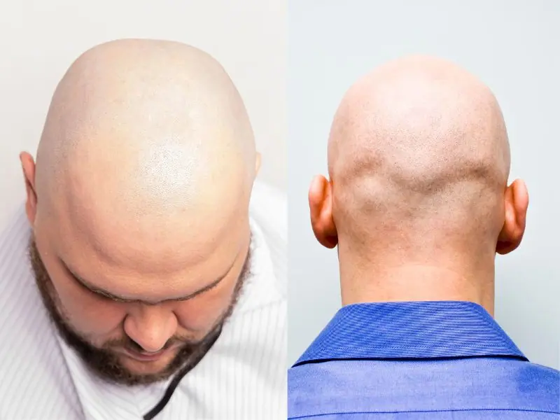 Alopecia Totalis