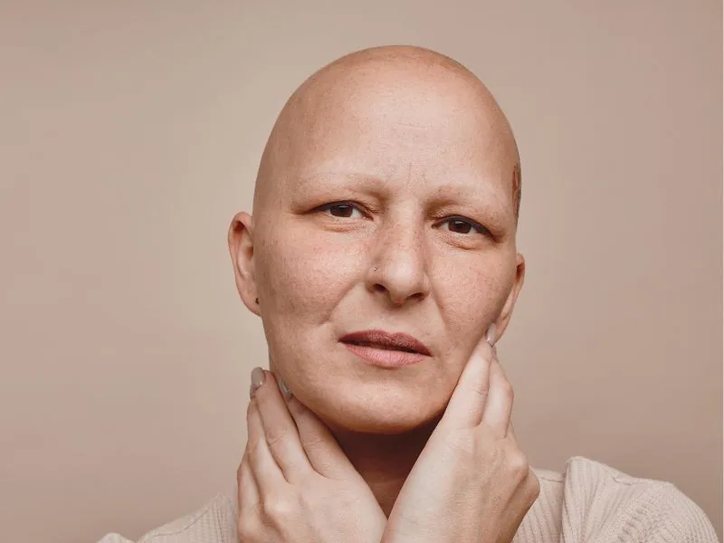 Alopecia Universalis