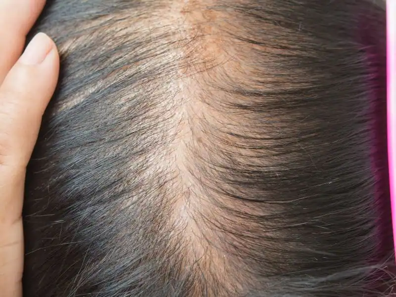 Diffuse Alopecia Areata