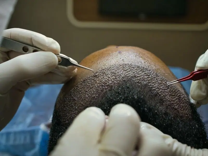 hair transplant