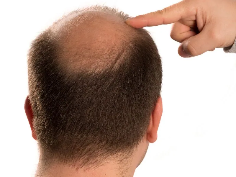 alopecia areata