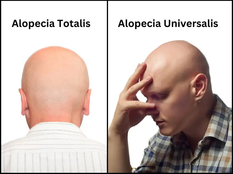 alopecia totalis and alopecia universalis