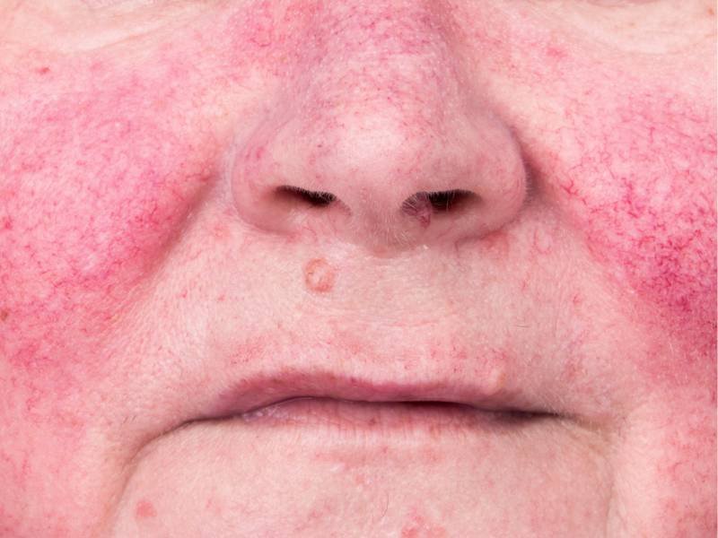 Rosacea