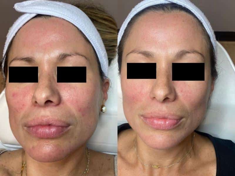 microneedling rosacea before and after