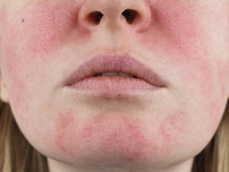 rosacea symptoms