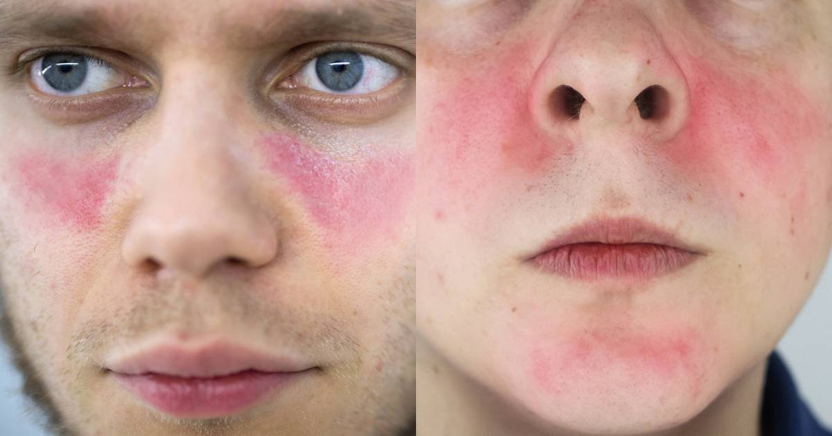 lupus vs rosacea