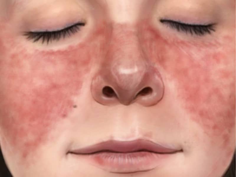 Lupus Vs Rosacea Differences Strong Causes And More 2024 