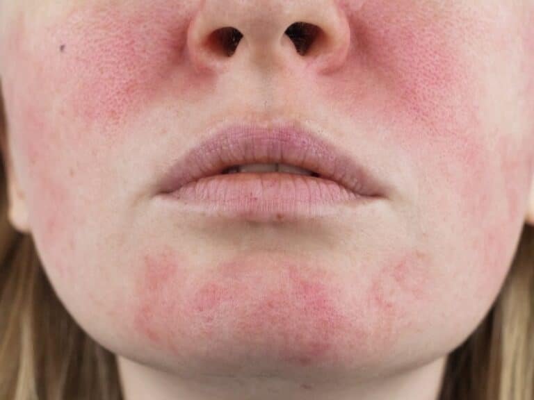 Lupus Vs Rosacea Differences Strong Causes And More 2024 