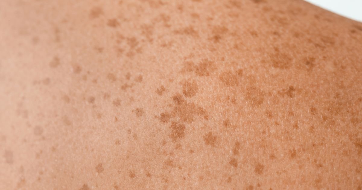 Tiny Black Dots on Skin Suddenly