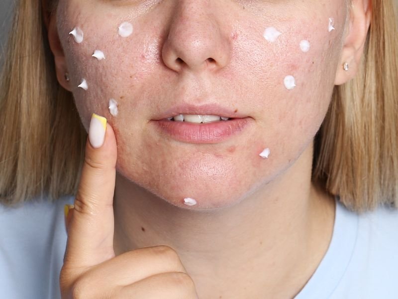 a woman applying acne cream on her face acne