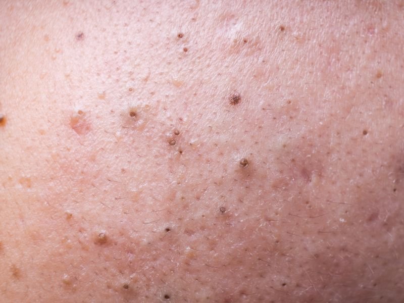 blackheads