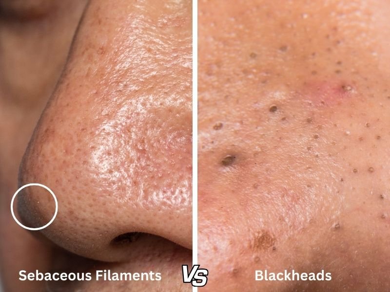 sebaceous filaments vs blackheads